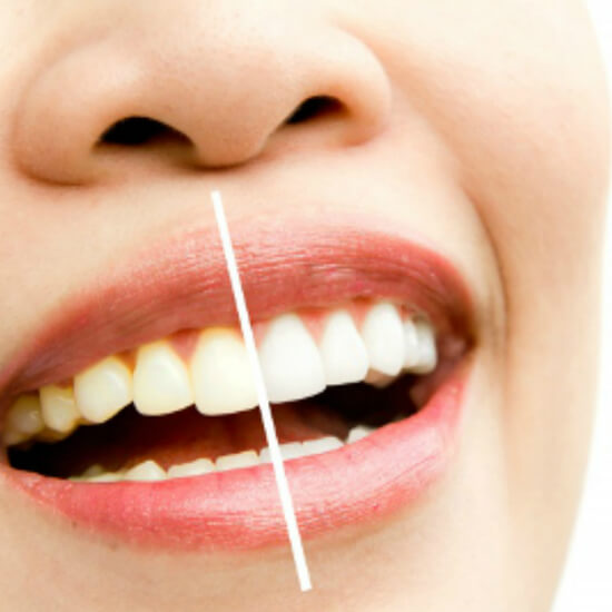 Teeth Whitening in Vasant Vihar
